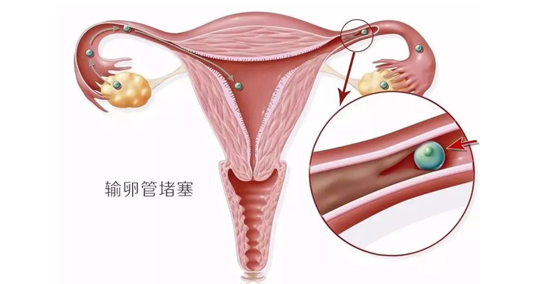 為什麼醫生建議女性不孕症要查輸卵管？哪種輸卵管檢查更好？