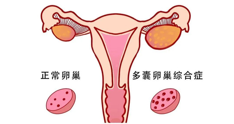 甲狀腺問題定多囊卵巢？香港荷爾蒙檢查項目點揀