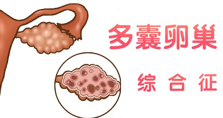 多囊卵巢綜合征拖久了會怎樣？